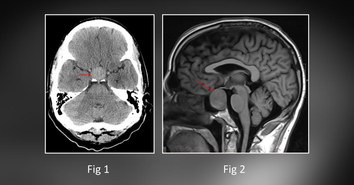 Case of a Man with a History of Hypertension and Dyslipidemia