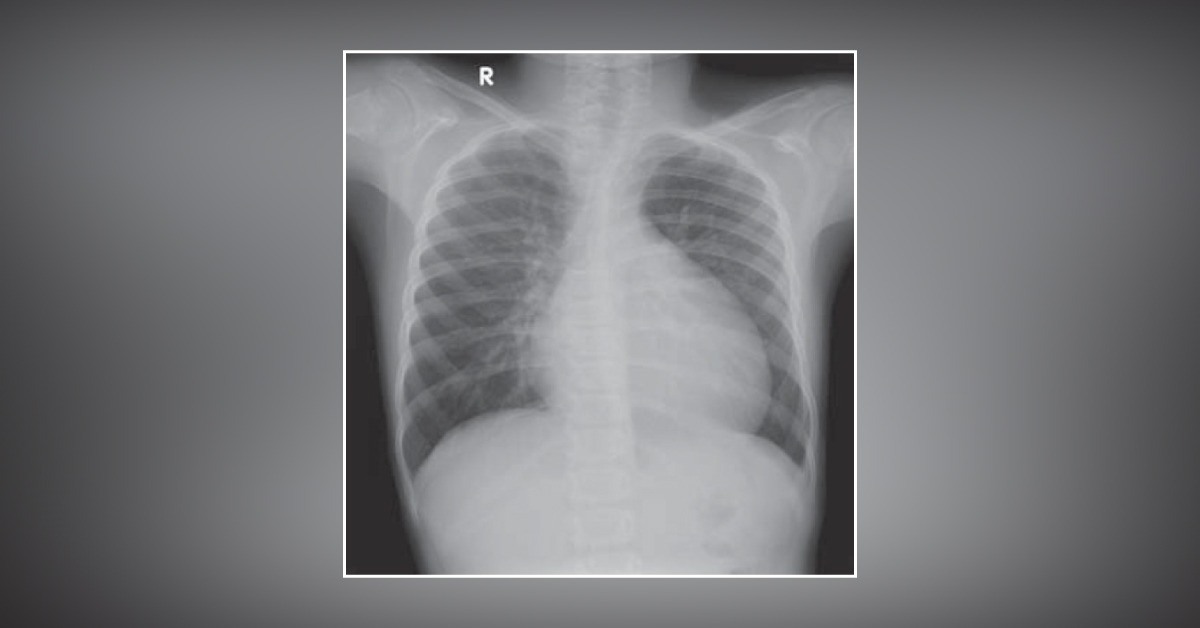 The Unsuspected Culprit: Case Of Pericardial Effusion With Methotrexate