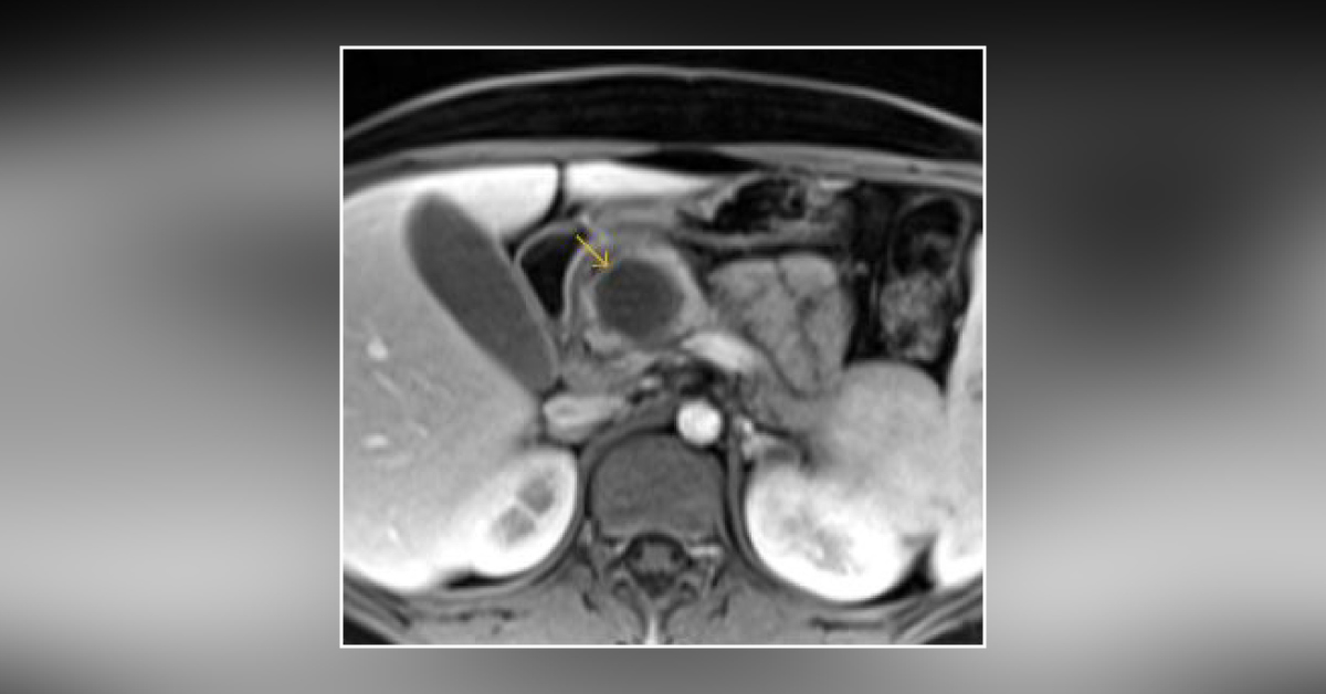 A Case of Persistent Emesis
