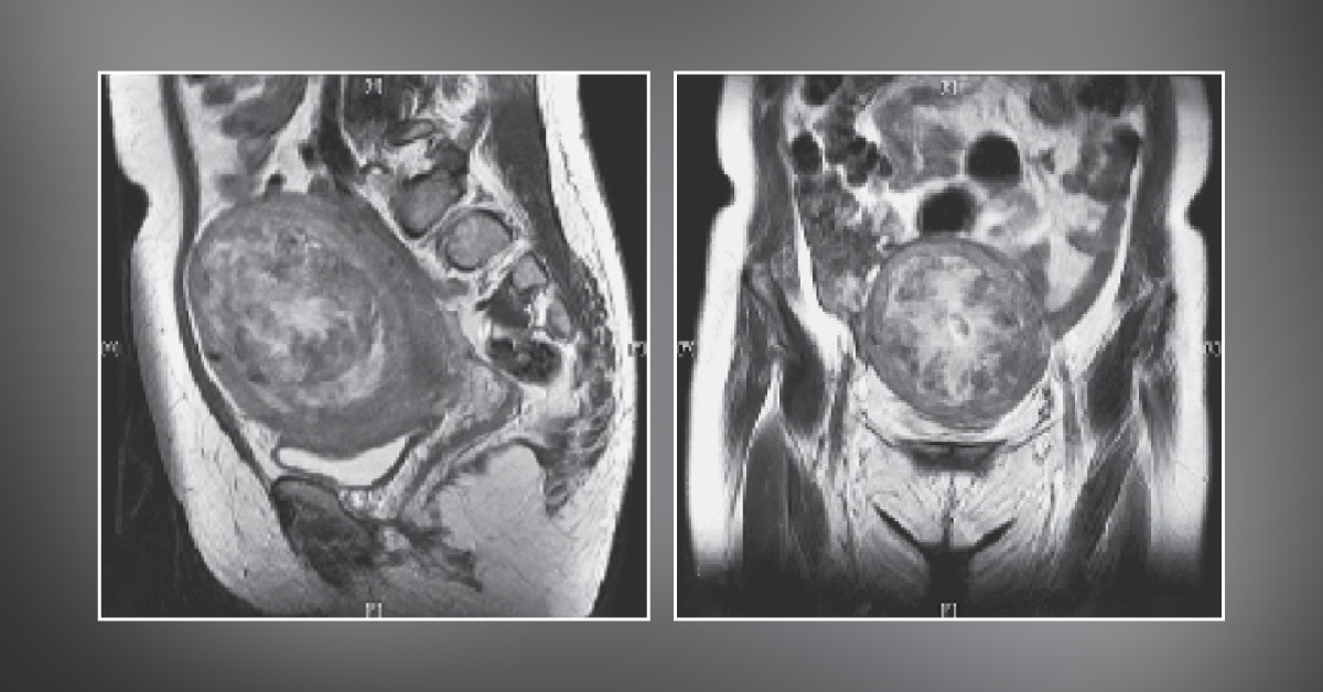 What's the Cause for Bloated Abdomen in This Woman?