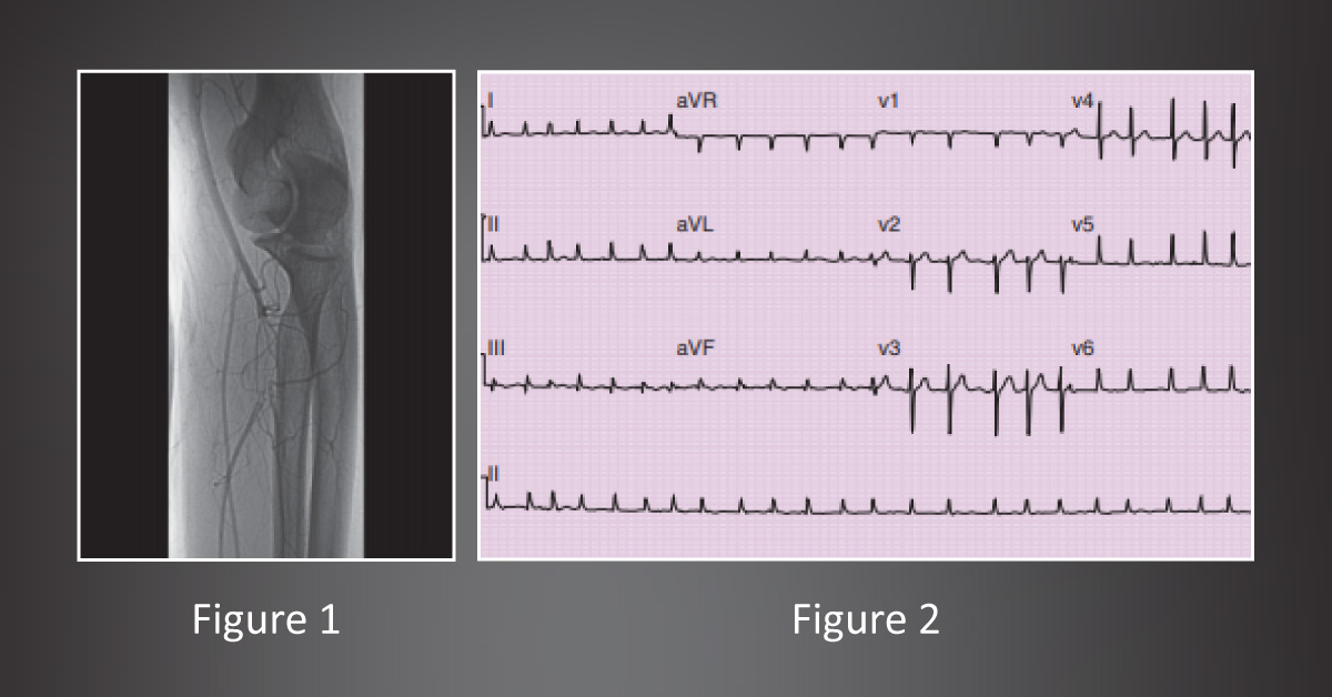 A Case of Sudden Arm Pain