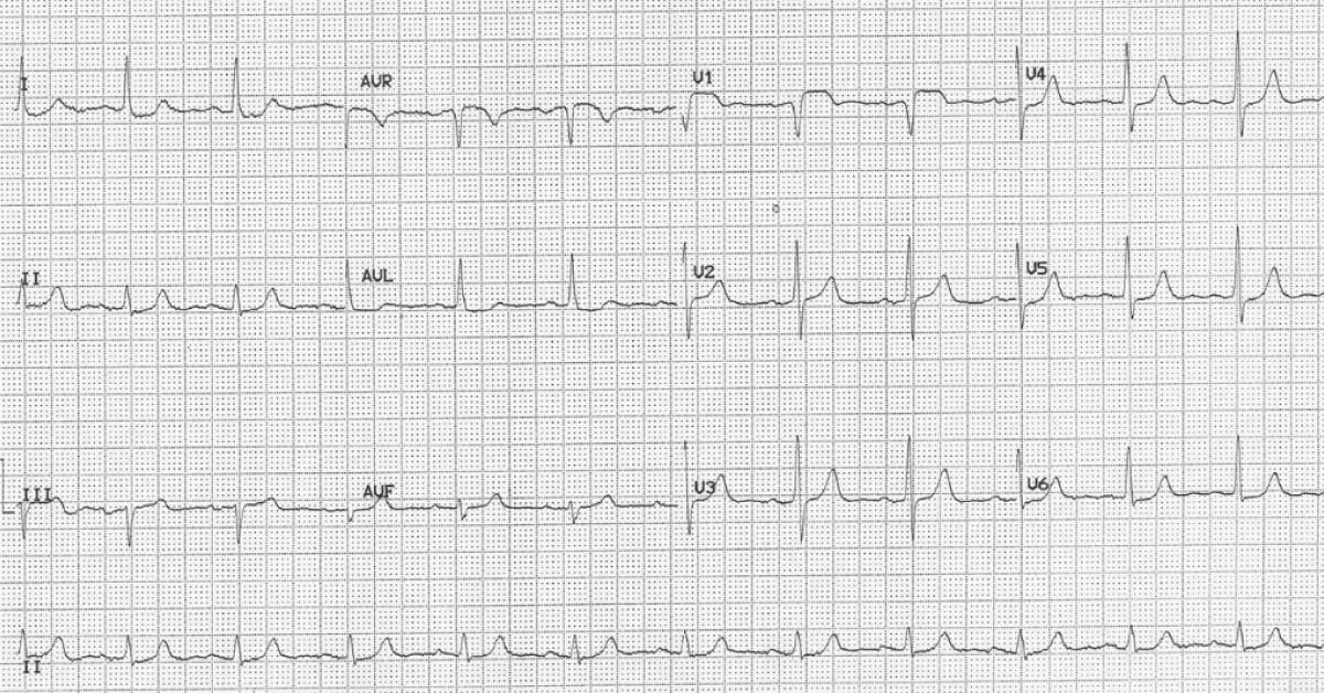 Can You Interpret This ECG of a Man with Central Chest Pain?