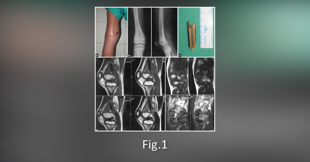 Foreign Body Trauma In Pediatrics: A Rising Concern