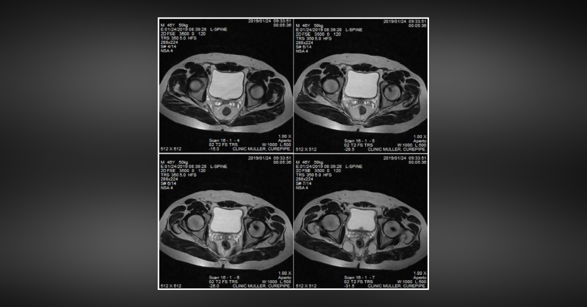 Pain In Hips 9 Years After Grafting