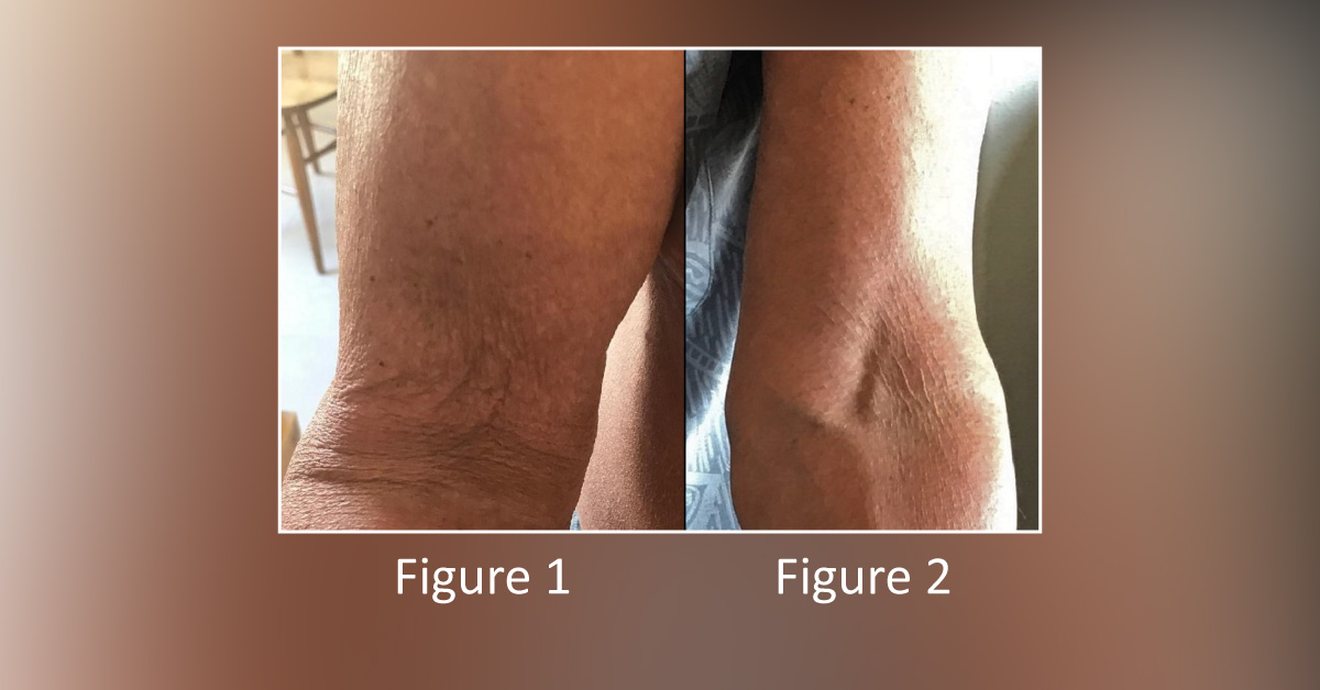 Diagnose The Elbow And Biceps Pain Of This Old Man