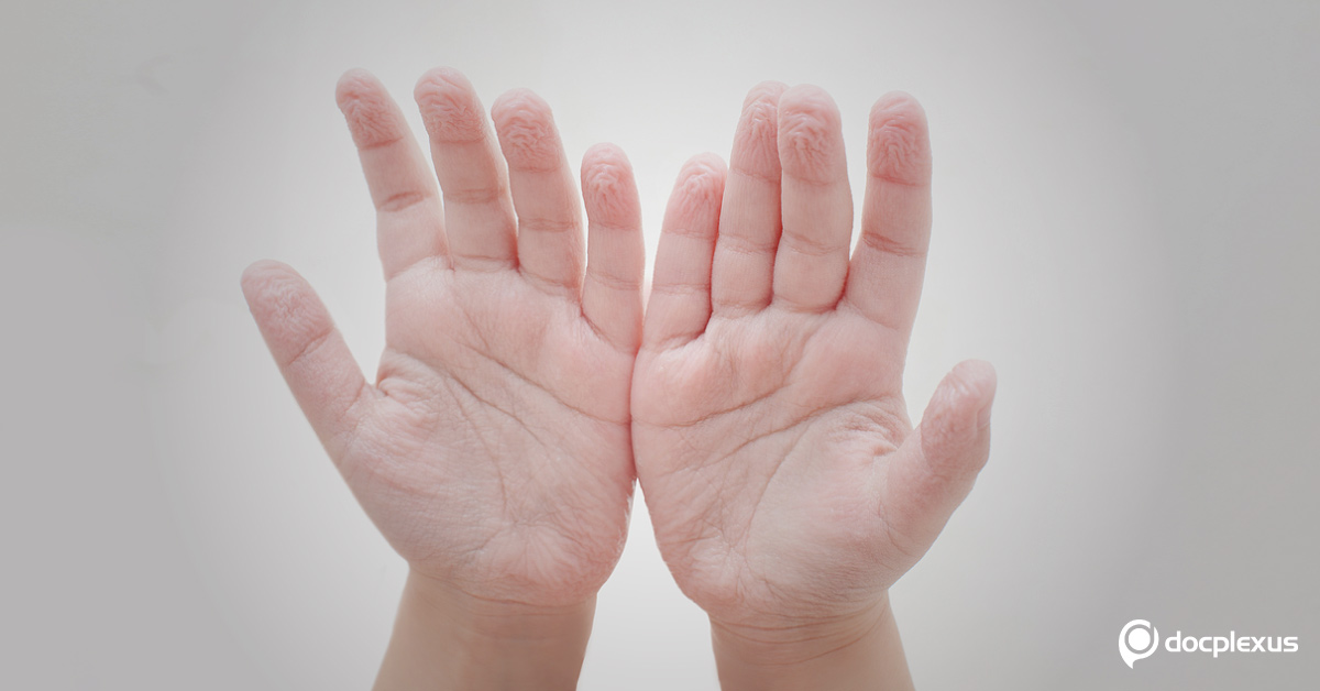 A Child with Severe Wrinkling of the Palms Skin
