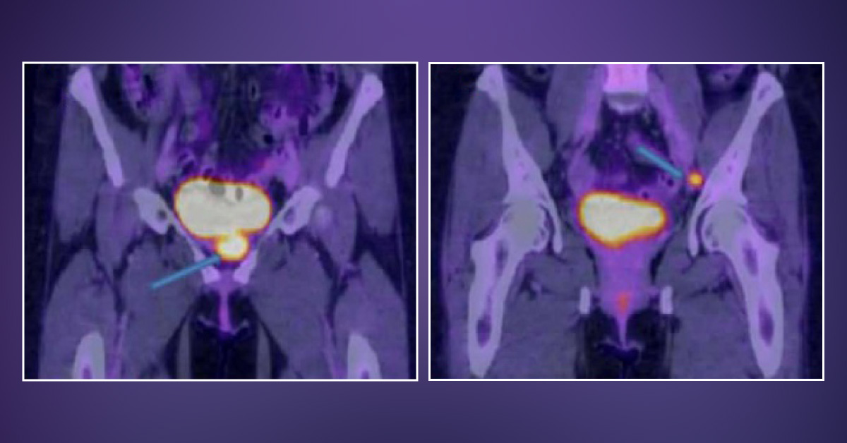 A Case Report: Malignant Paraganglioma of the Urinary Bladder