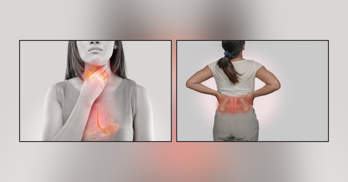 Common Acid Reflux Medications Linked To Increased Kidney Disease Risk