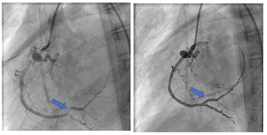 Cardiovascular Complications in a Patient with Moyamoya Disease