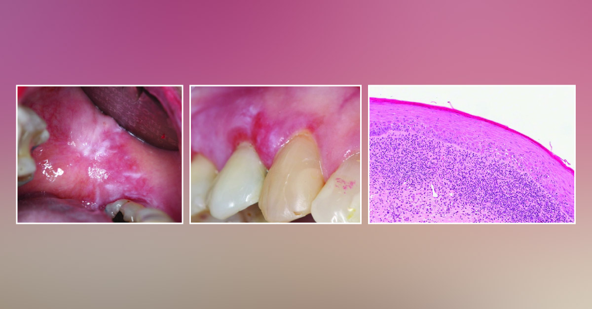 Oral Lesion in an Old Patient: A Case Report