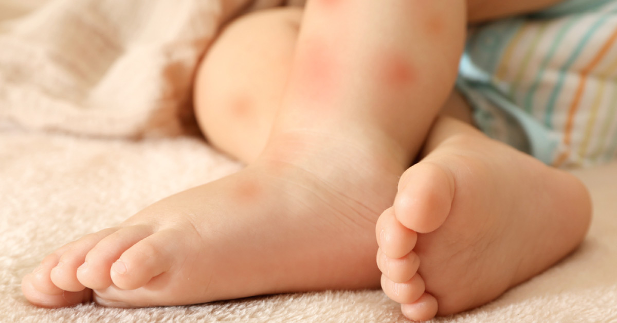What Would Be Your Approach for Treating This Fussy Infant with Rash?