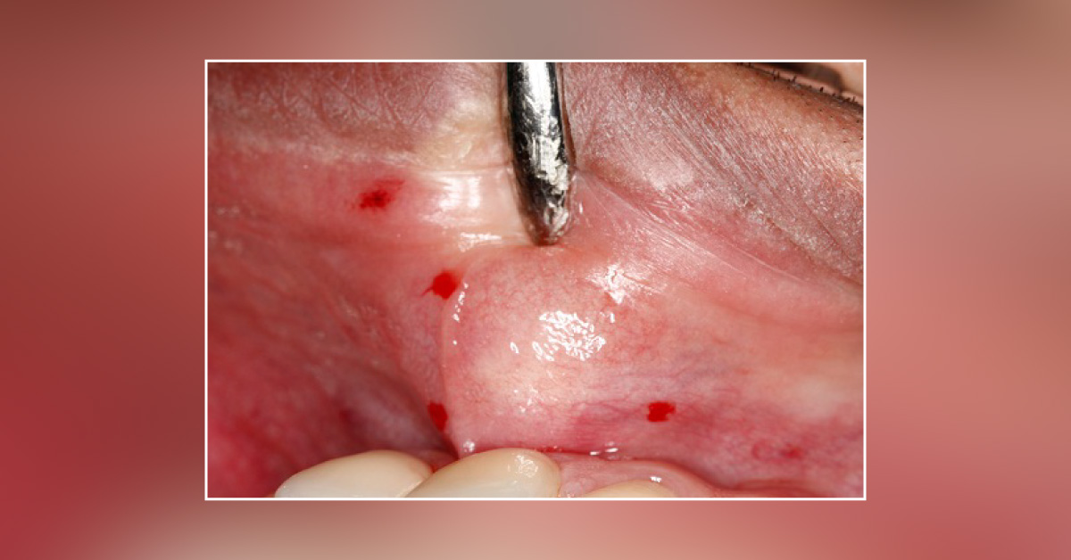 A Man with Dome-Shaped Swelling on the Upper Lip