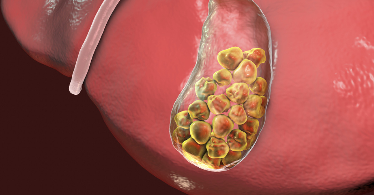 Asyptomatic Gall Bladder Stones Mostly Remain Asymptomatic