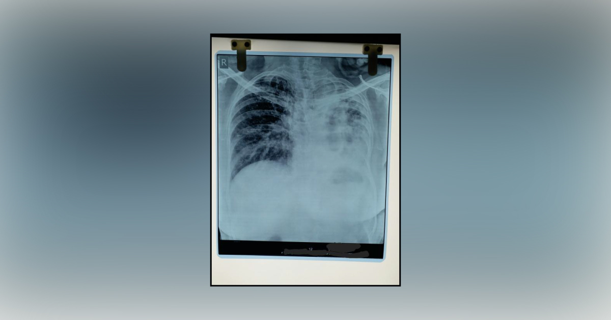 Case Of Severe Breathlessness On Exertion And Routine Work