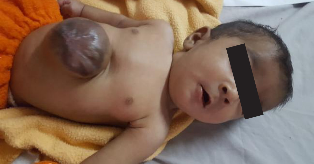 Age Of Operations For Umbilical Omphalocele