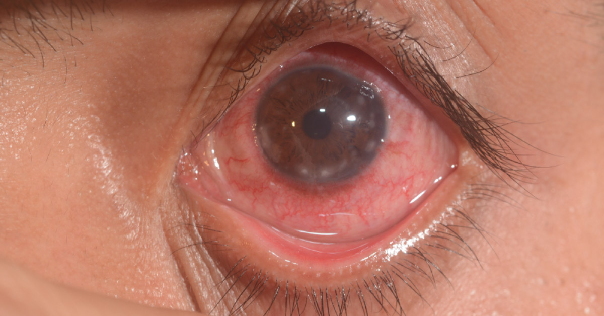 Old Treatments Of Vernal Keratoconjunctivitis