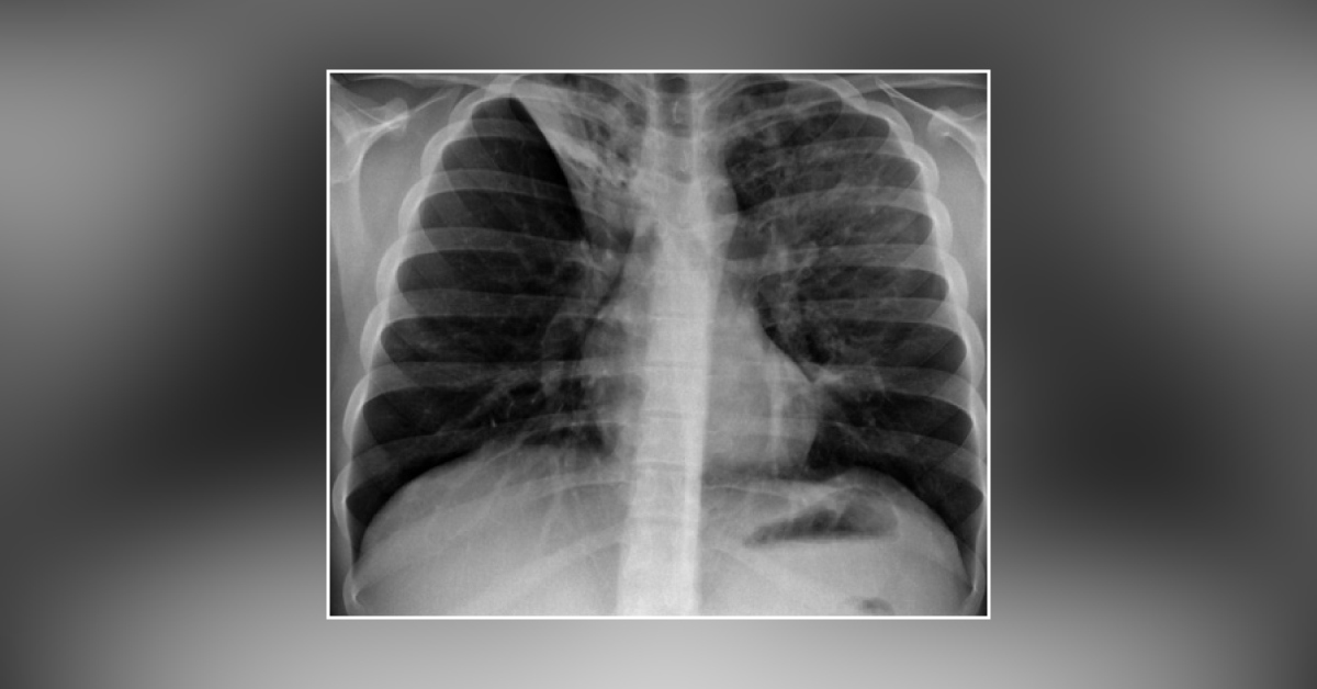 Describe This Lung Abnormality