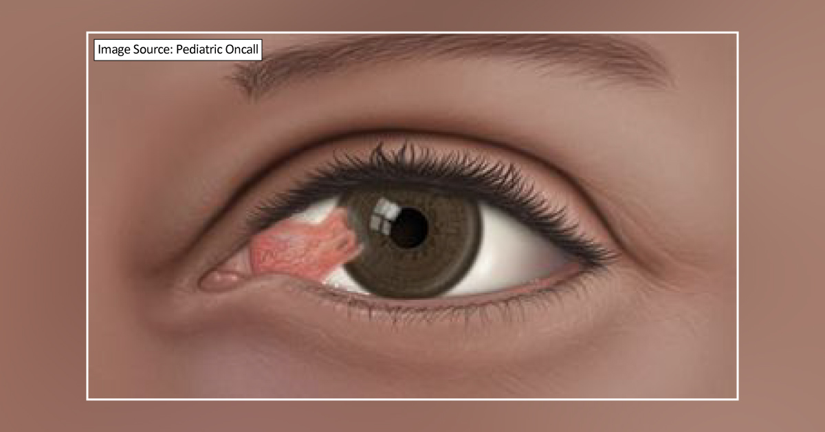 Complications & Differential Diagnosis of Eales Disease