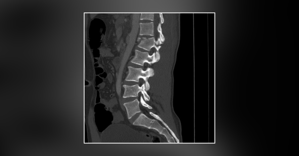 Which Organs Can be Damaged in Chance Fractures?