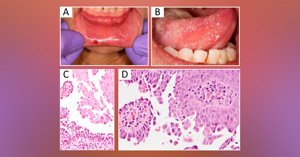 Case of a Woman with Multiple Intraoral Ulcerations