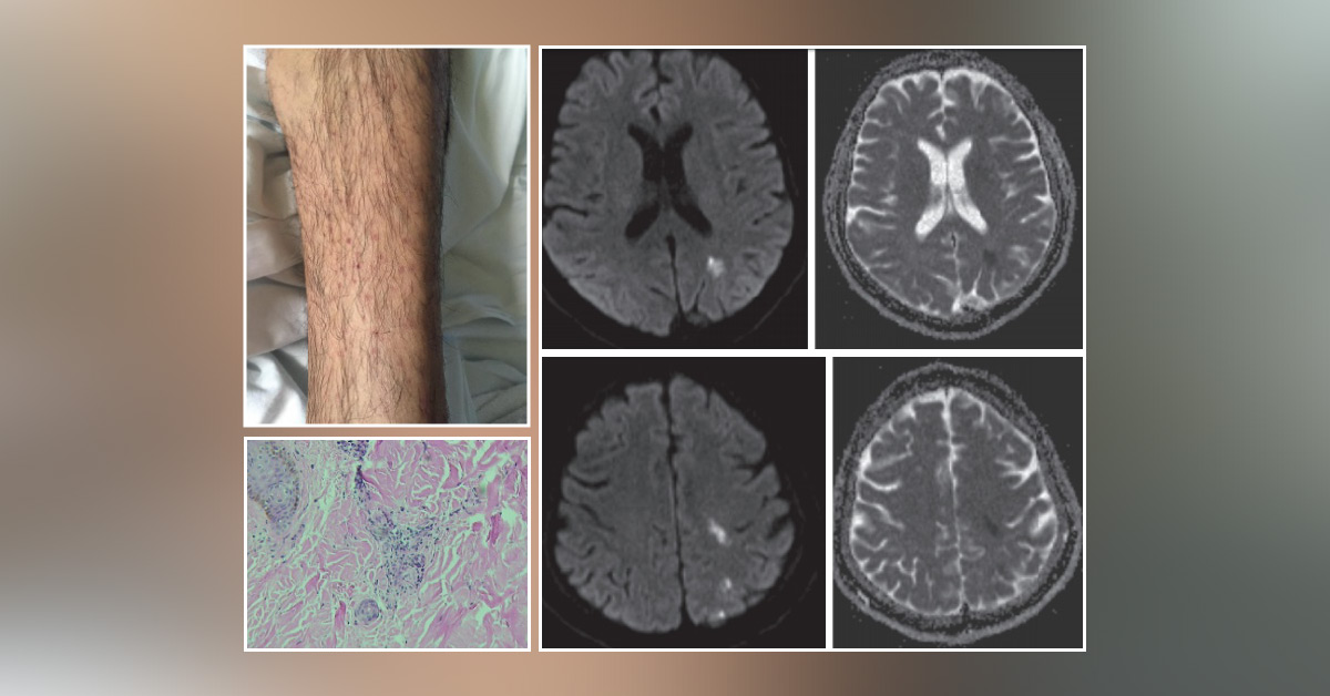 A Challenging Case of an Infection Mimicking Another Condition