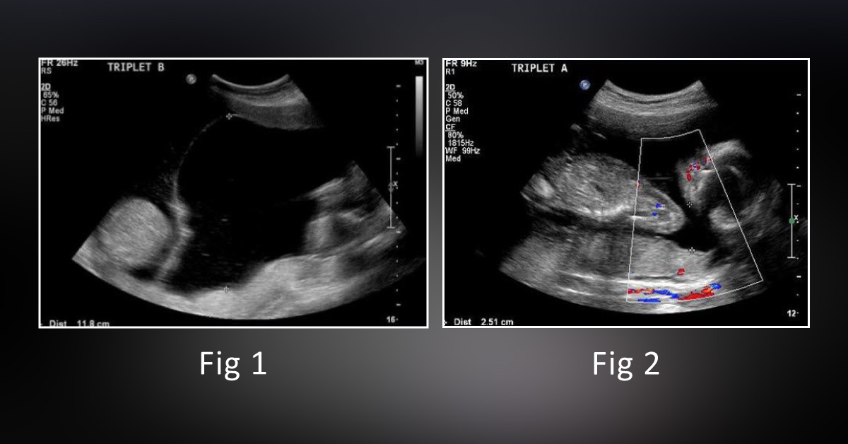 A Triplet Pregnancy At 20 Weeks