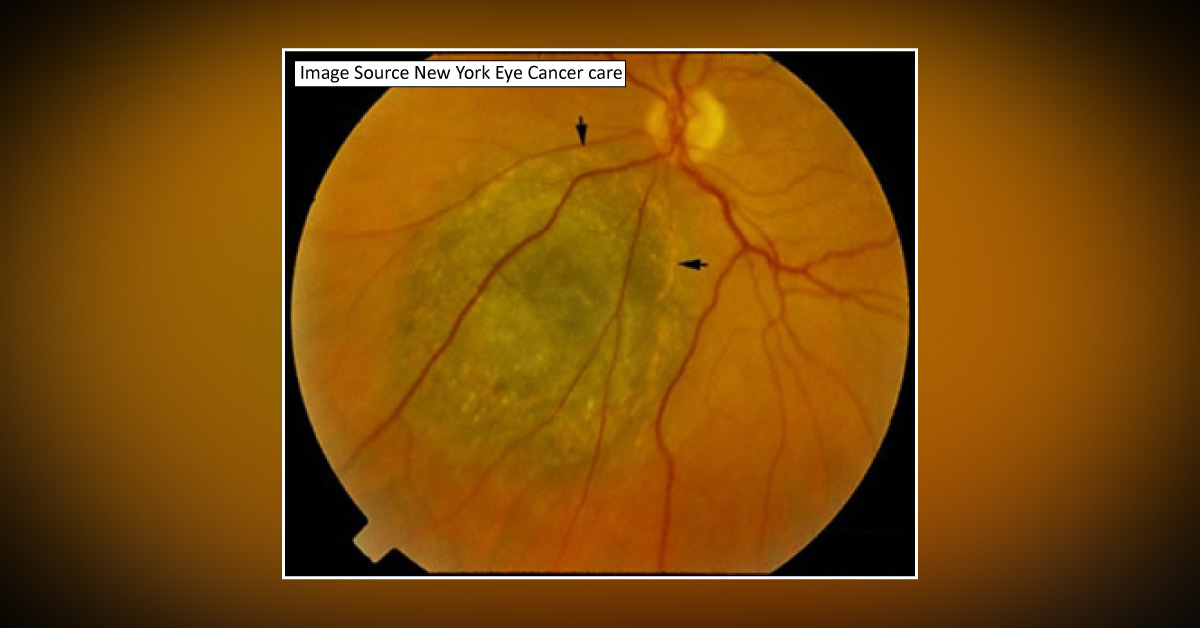 Choroidal Melanomas And Its Atypical Presentations