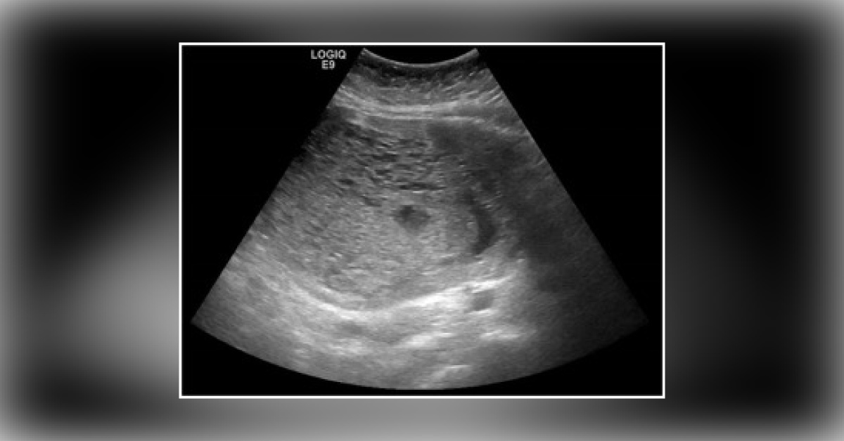 Advanced Gestational Trophoblastic Disease