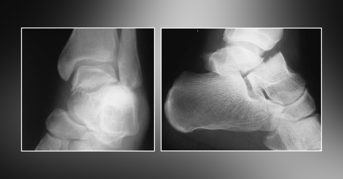 A 45-Year-Old Man With Painful Foot