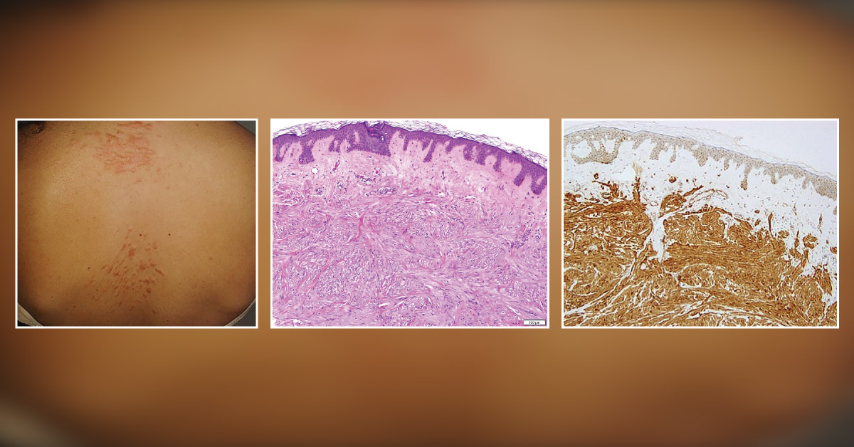 Diagnose This Case of Multiple Skin Lesions