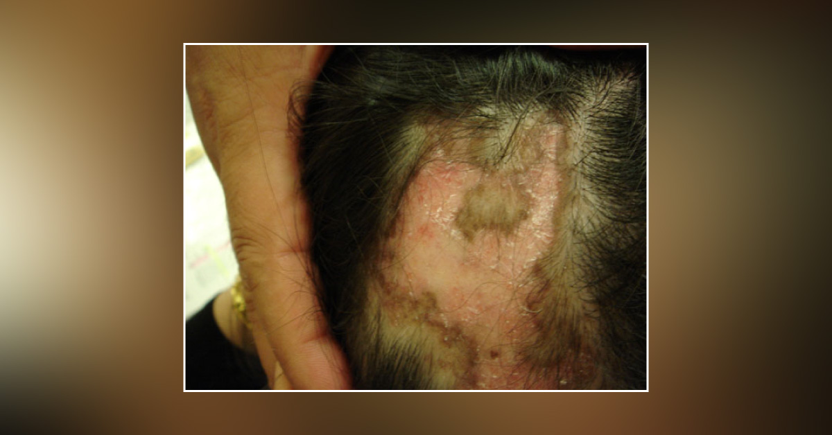 A Young Woman with Hair Loss