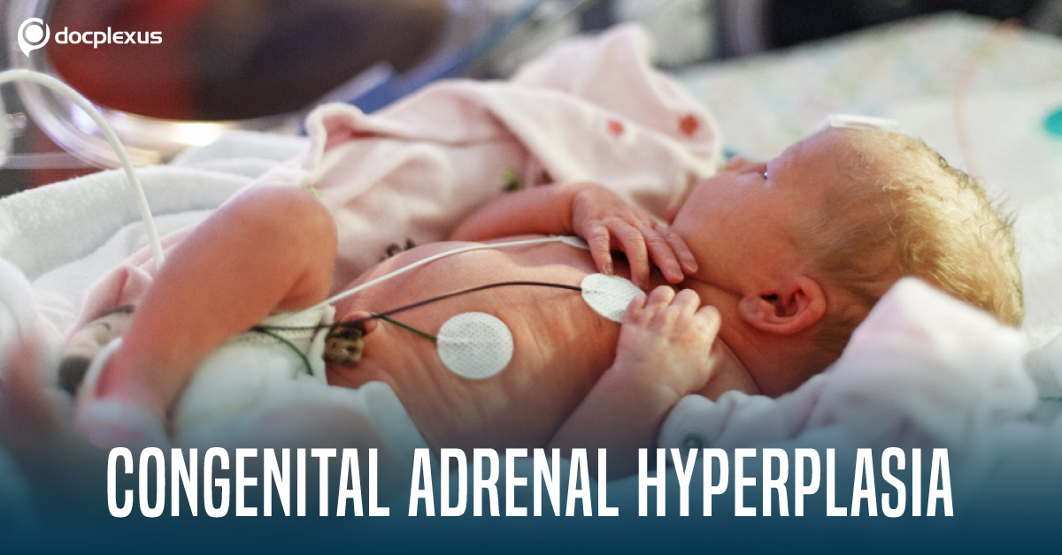 Congenital Adrenal Hyperplasia due to Steroid 21-Hydroxylase Deficiency: Endocrine Society Clinical Practice Guidelines (2018)