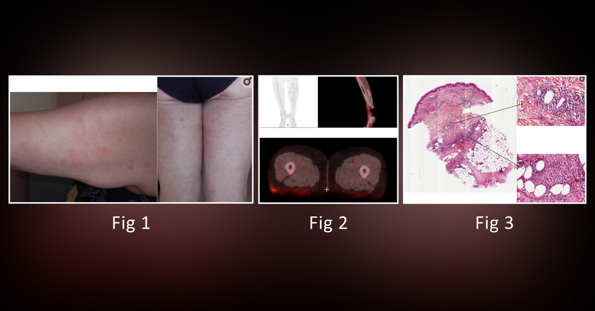 Solve This Challenging Case of a  Patient with Bypass Obesity Surgery