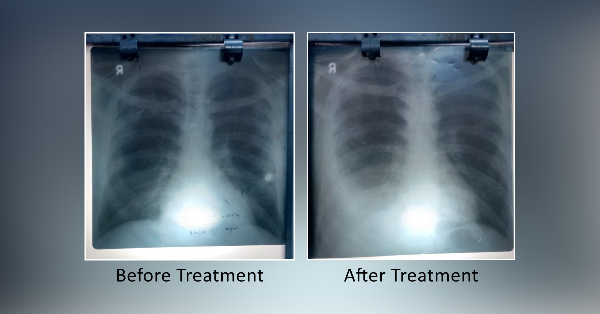 Right Sided Pleural Effusion