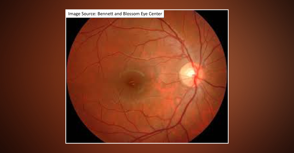 Causes Of Angioid Streaks