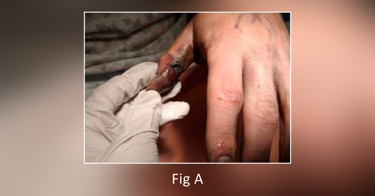 Injury Due to Vaporizer Explosion: How Will You Manage the Wound?
