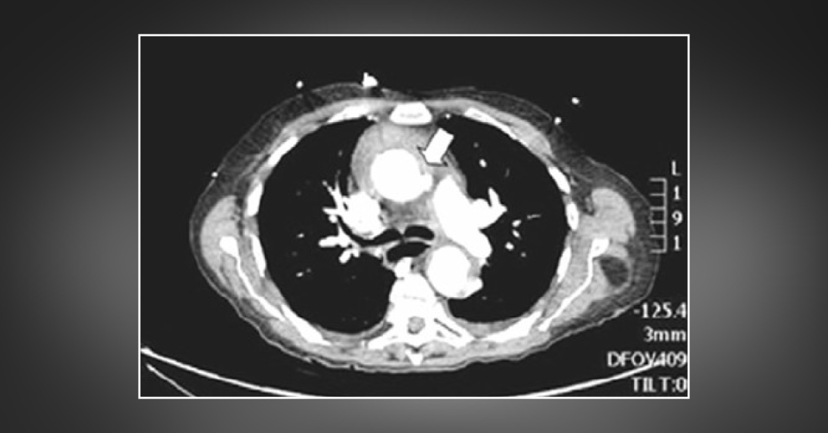 An Old Man with Severe Chest Pain