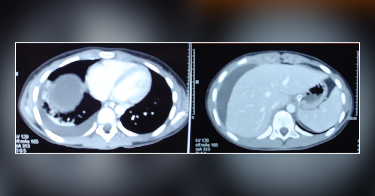 A Pediatric Case After a Fall from A Bicycle