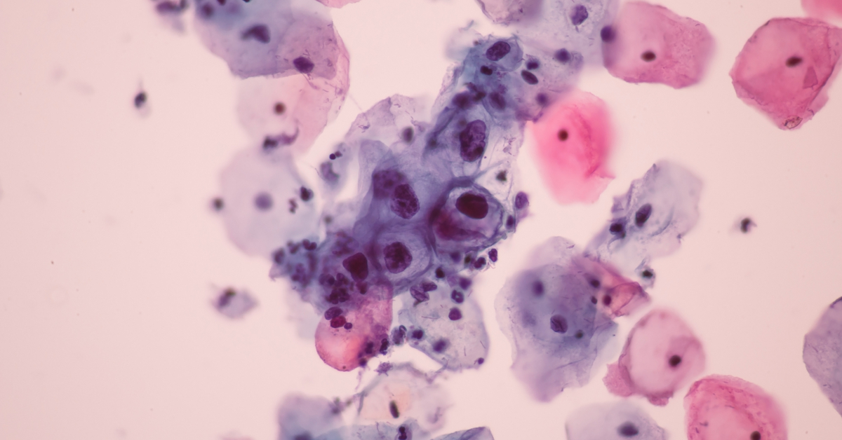 Prevalence Of HPV In Oropharyngeal Cancer In North India