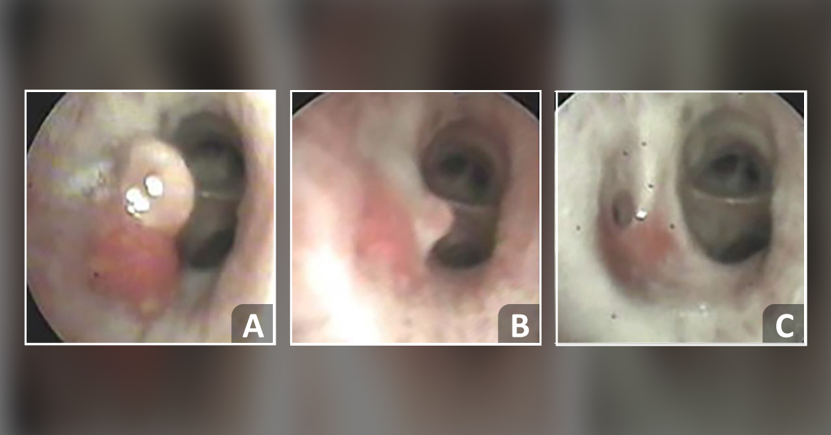 Diagnose This Case of Hemoptysis