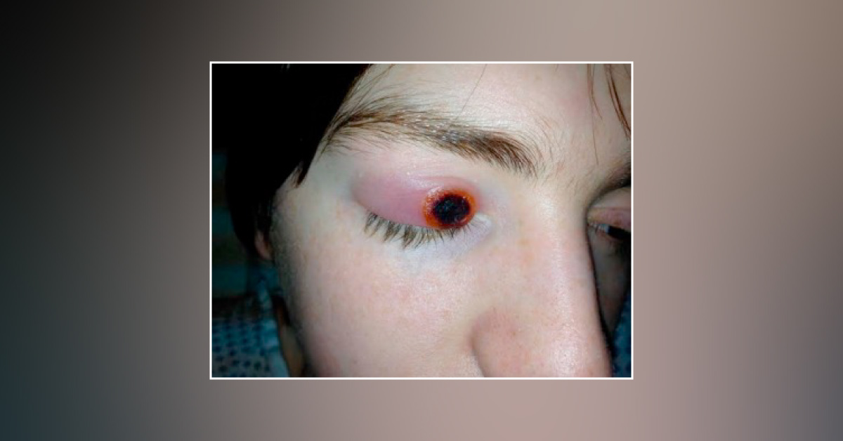 An Unusual Lesion on the Eyelid
