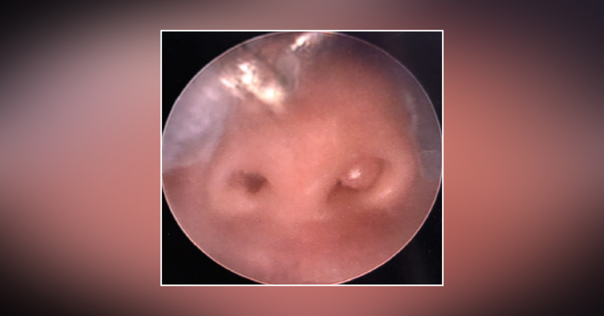 Can You Identify, What Is This Nasal Cavity Mass?