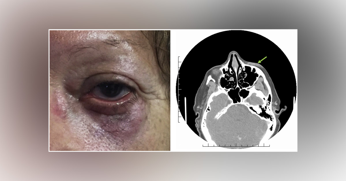 A Rare Orbital Tumor