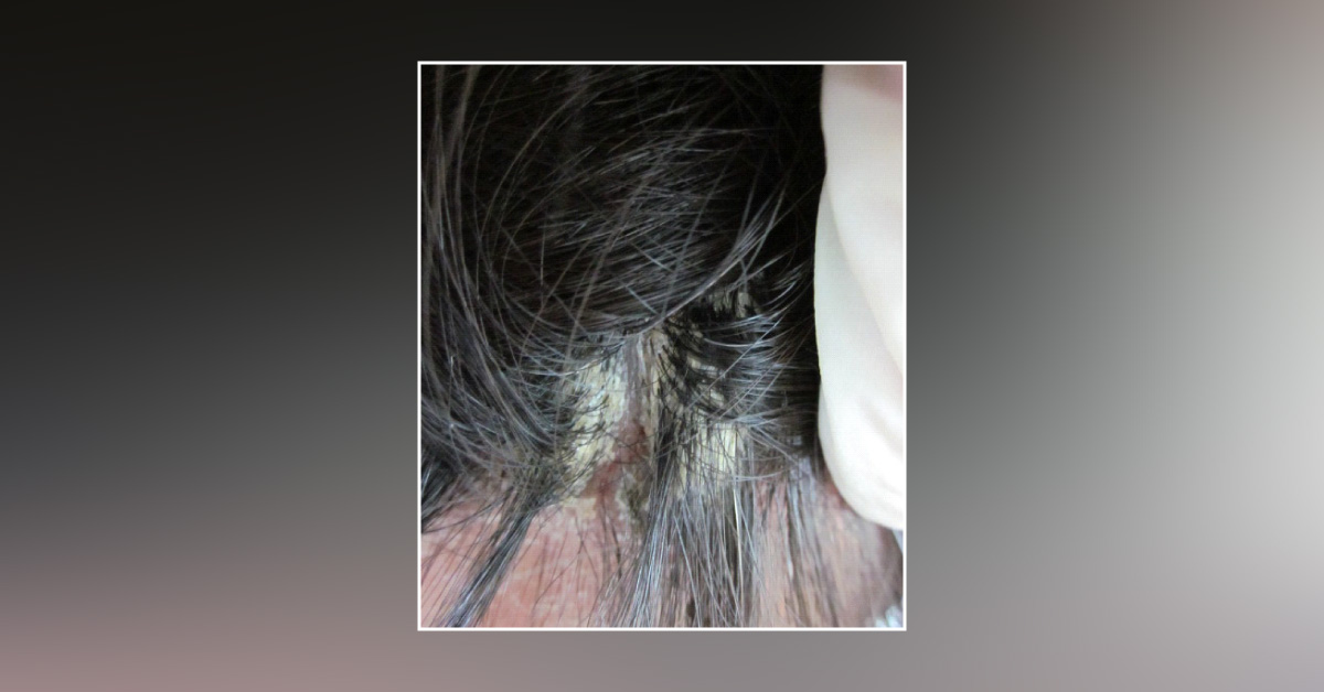 Case of Dandruff and Hair Lesions