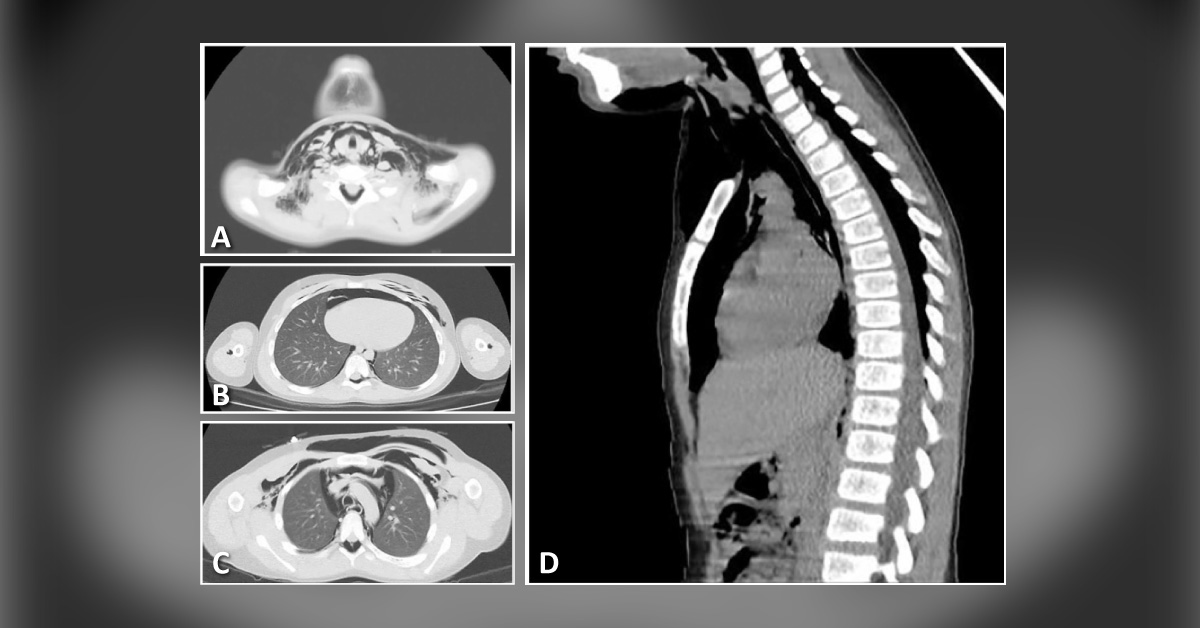Vomiting and Dyspnea After Adenotonsillectomy: What Can Be the Cause?