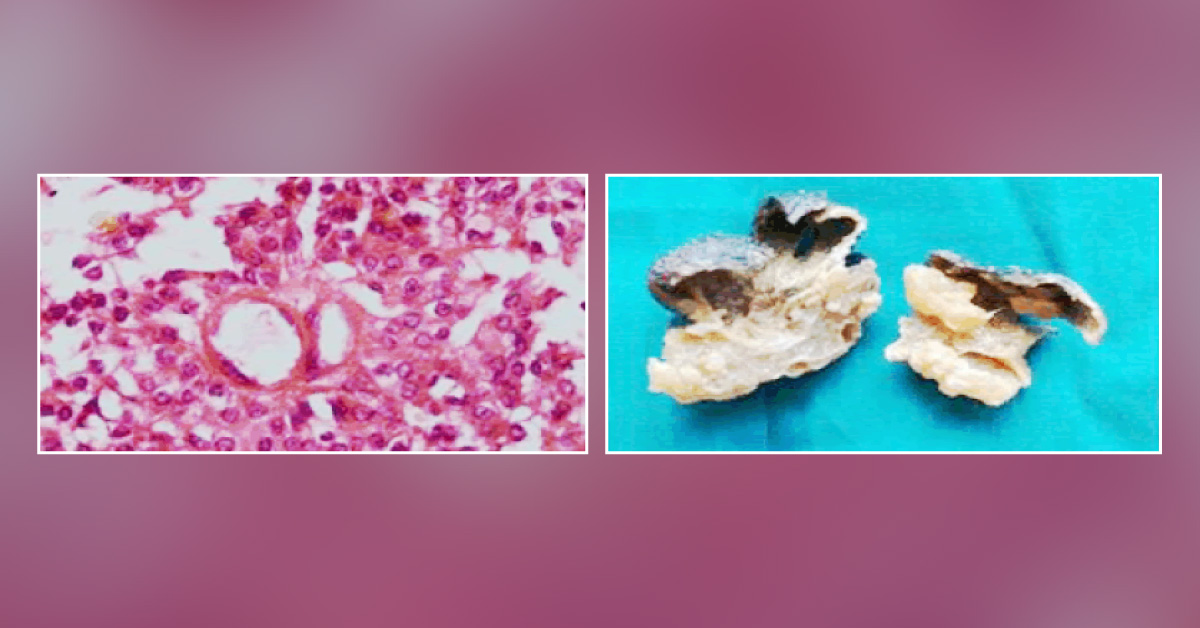 Case of a Woman with a Swelling on the Thigh
