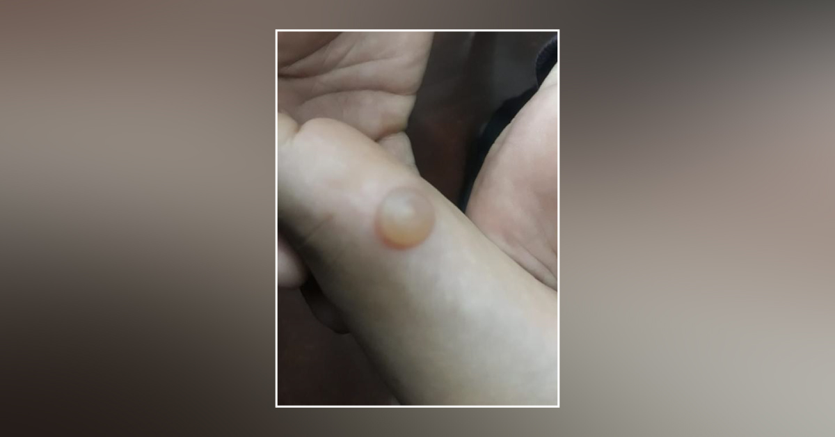 Diagnosis Of The Blister