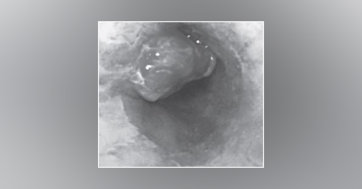 Case of Difficulty in Swallowing