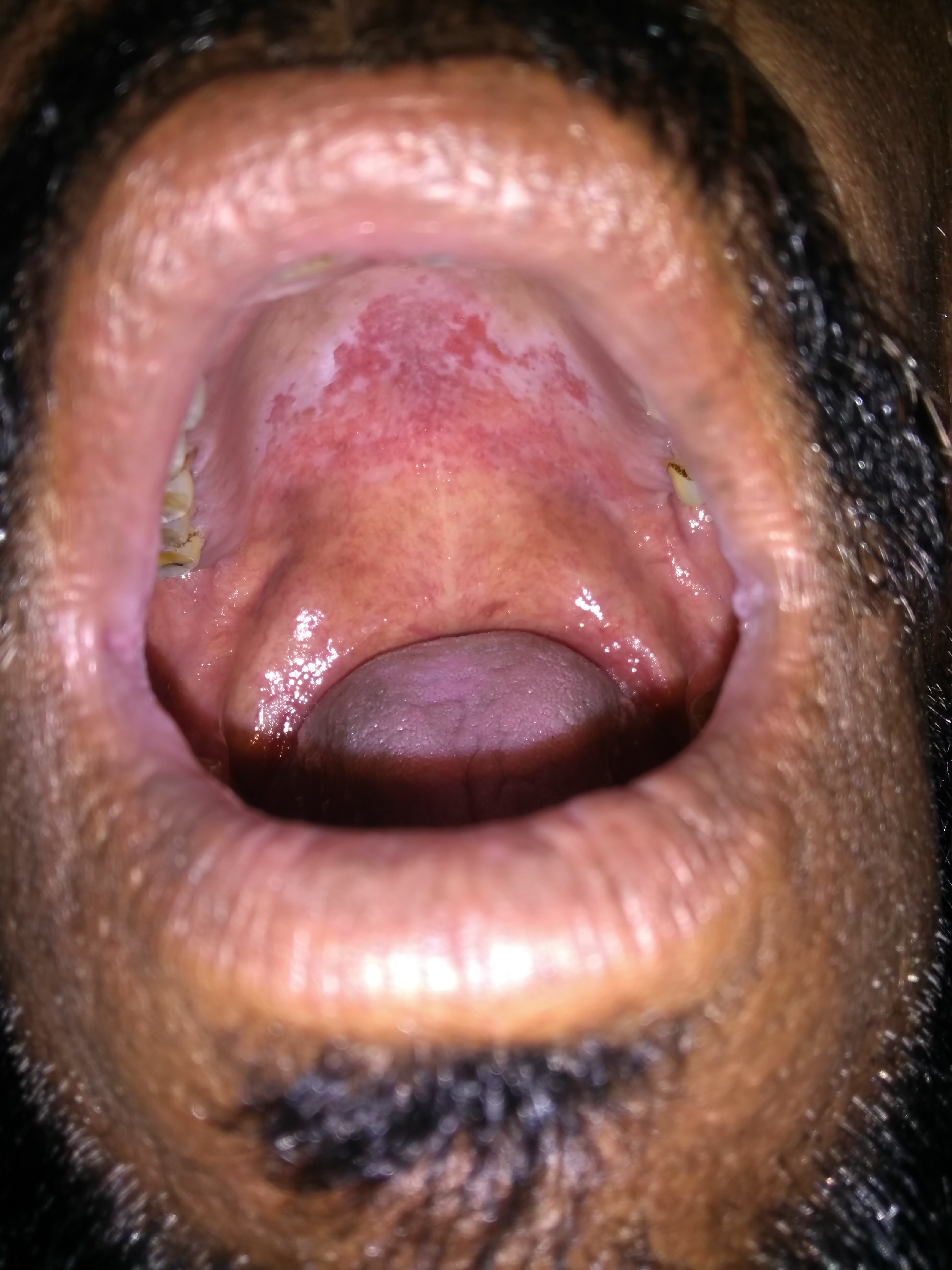 39- Year- Old Male Patient With H/o Tobacco Chewing