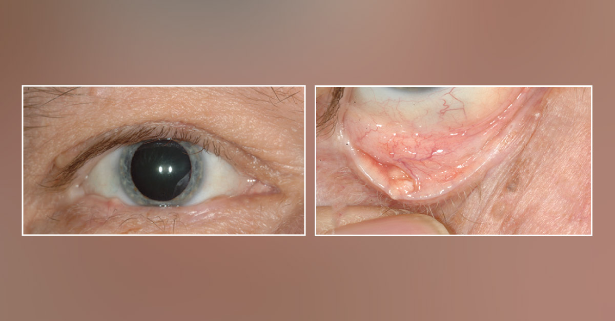 Is it Just Another Chalazion or Something Else?